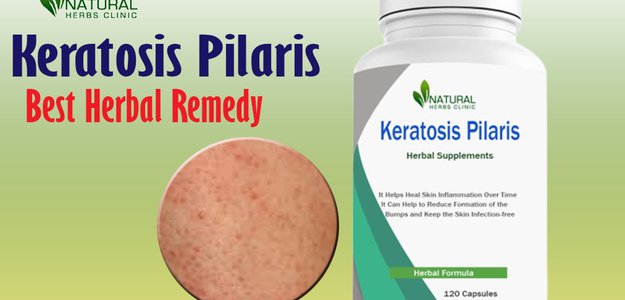 Keratosis Pilaris Arms Treatment at Home: Natural Remedies for Smooth Skin