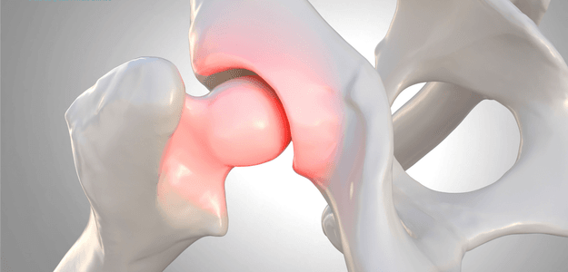 A Quick Guide to Femoroacetabular Impingement