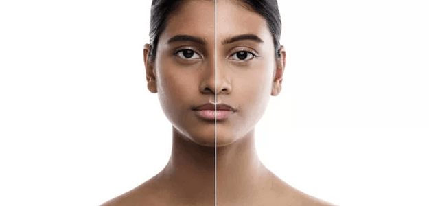 Unveiling Permanent Skin Whitening Options in Dubai