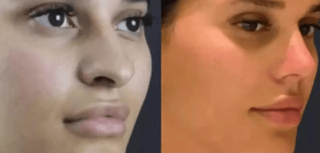 How Rhinoplasty in Dubai is Evolving with 3D Imaging Technology