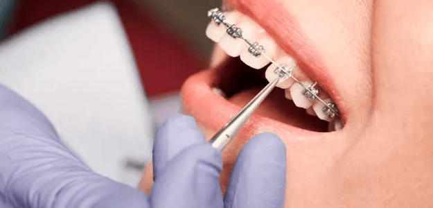 The Hidden Advantages of Braces Past a Straighter Grin