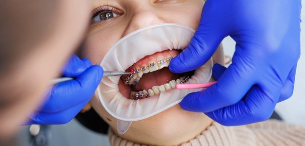 What Are The Significant Causes Of Bottom Teeth Braces?