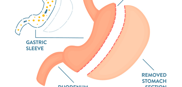 Is Gastric Sleeve Surgery Right for You? Find Out