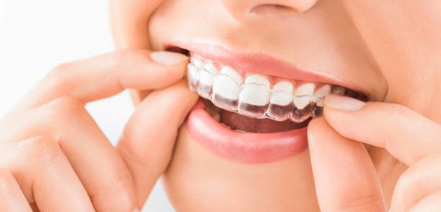 Discover the Benefits of Toronto Invisalign for a Confident Smile