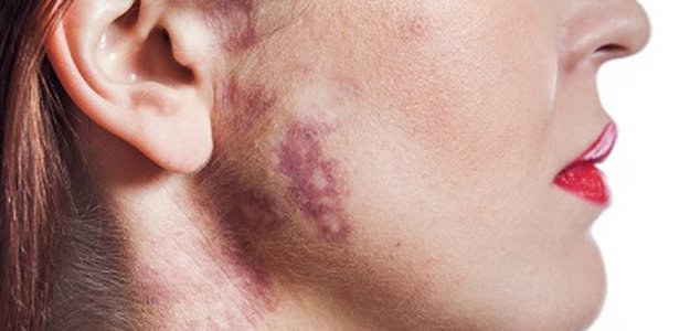 Safe and Effective Birthmark Removal in Islamabad