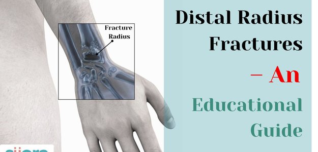 Distal Radius Fractures – An Educational Guide