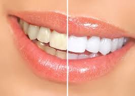 How Much Does Teeth Whitening Cost in Dubai?