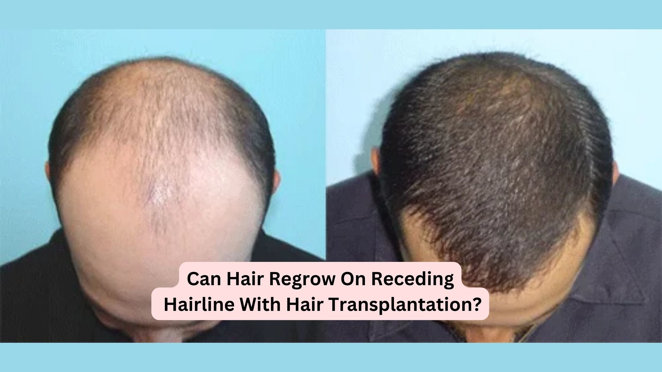 Can Hair Regrow On Receding Hairline With Hair Transplantation? — SB ...