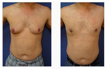 What Are the Latest Trends in Gynecomastia Surgery?